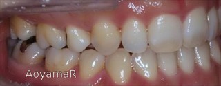 下顎歯列の近心位、重度の叢生、上下顎歯列の狭窄による開咬