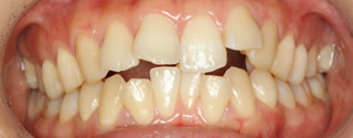 上下顎歯列狭窄による前歯の叢生および開咬