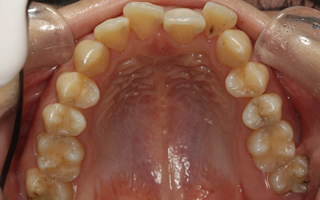 上下顎歯列狭窄による前歯の叢生および開咬