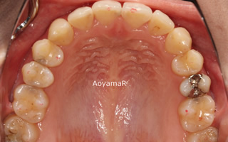 上下顎歯列狭窄による前歯の叢生および開咬