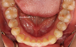 上下顎歯列狭窄による前歯の叢生および開咬