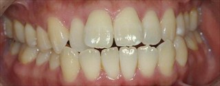 上顎歯列狭窄による前歯の叢生および開咬