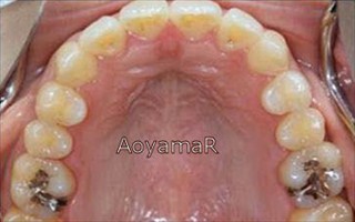上顎歯列狭窄による前歯の叢生および開咬