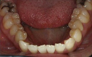 上顎歯列狭窄による前歯の叢生および開咬