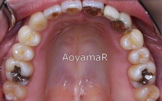 上下顎歯列の狭窄による上顎前歯の開咬