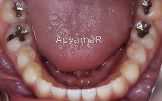 上下顎歯列の狭窄による上顎前歯の開咬