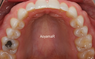 上顎歯列の狭窄による開咬