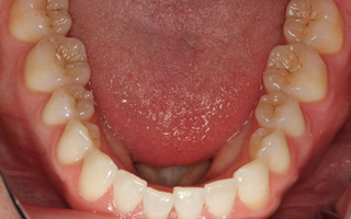 上顎歯列の狭窄による開咬