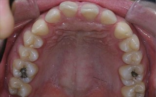 上顎前歯の挺出、下顎前歯の舌側傾斜による過蓋咬合