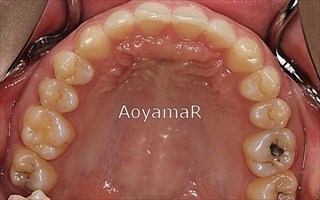 上顎前歯の挺出、下顎前歯の舌側傾斜による過蓋咬合