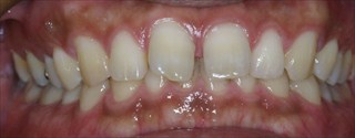 上下顎歯列の狭窄、上顎右側近心位、上顎右側大臼歯の反対咬合