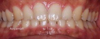 上下顎歯列の狭窄、上顎右側近心位、上顎右側大臼歯の反対咬合