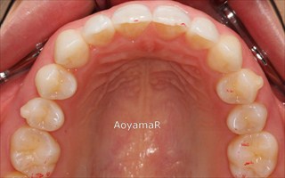 上下顎歯列の狭窄、上顎右側近心位、上顎右側大臼歯の反対咬合