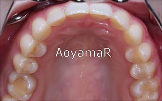 上下顎に軽度の叢生を伴う過蓋咬合、上下歯列の狭窄
