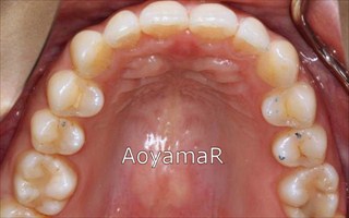 過蓋咬合を伴う重度の叢生