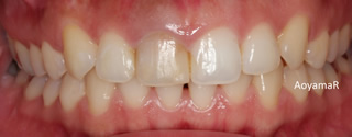 上顎大臼歯近心位による中等度の叢生を伴う過蓋咬合