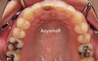 上顎大臼歯近心位による中等度の叢生を伴う過蓋咬合