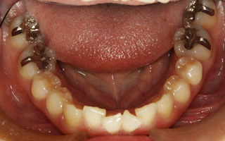 上顎大臼歯近心位による中等度の叢生を伴う過蓋咬合