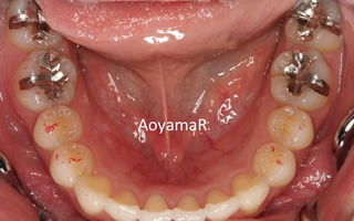 上顎大臼歯近心位による中等度の叢生を伴う過蓋咬合