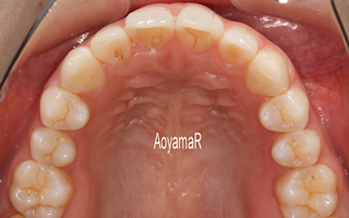 上下顎に叢生を伴う過蓋咬合、上下歯列の狭窄