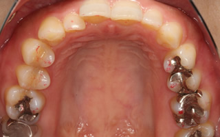 上下顎に叢生を伴う過蓋咬合、上下歯列の狭窄