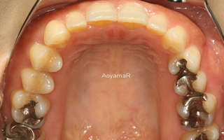 上下顎に叢生を伴う過蓋咬合、上下歯列の狭窄