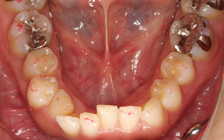 上下顎に叢生を伴う過蓋咬合、上下歯列の狭窄