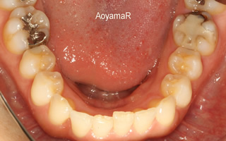 上下顎に叢生を伴う過蓋咬合、上下歯列の狭窄