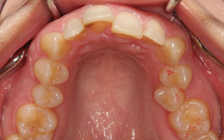 過蓋咬合を伴う重度の叢生