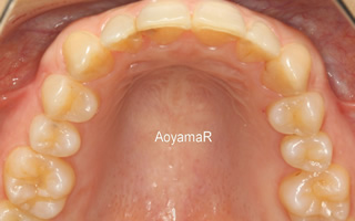 過蓋咬合を伴う重度の叢生