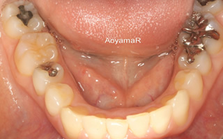 過蓋咬合を伴う重度の叢生