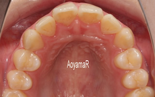 上下顎に叢生を伴う過蓋咬合