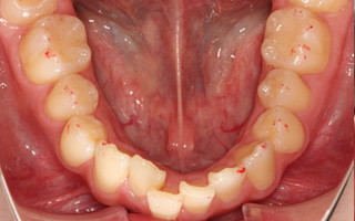 上下顎に叢生を伴う過蓋咬合
