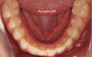 上下顎に叢生を伴う過蓋咬合