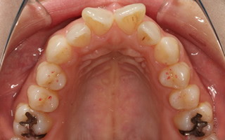 上顎中切歯翼状捻転を伴う上顎前突、重度の過蓋咬合