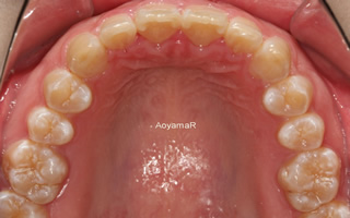 上顎中切歯翼状捻転および上顎前突を伴う空隙歯列過蓋咬合