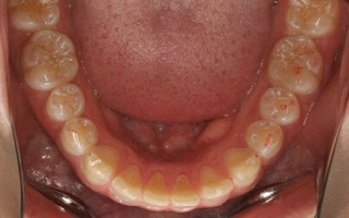 上顎中切歯翼状捻転および上顎前突を伴う空隙歯列過蓋咬合