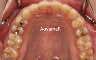 上顎右側の近心位による上顎前歯の唇側傾斜