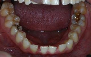 上顎右側の近心位による上顎前歯の唇側傾斜