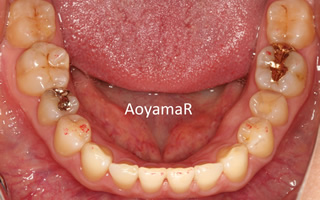 上顎右側の近心位による上顎前歯の唇側傾斜