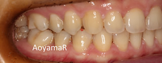 上顎右側の近心位による上顎前歯の唇側傾斜