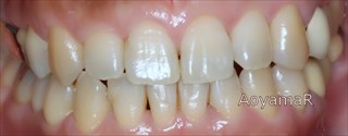 上下歯列の狭窄および下顎前歯の挺出による上顎前歯の唇側傾斜