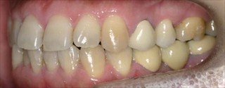 上下歯列の狭窄および下顎前歯の挺出による上顎前歯の唇側傾斜