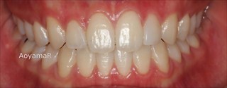 上顎側切歯矮小歯による上下前歯のスペースの発現