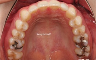 上顎側切歯矮小歯による上下前歯のスペースの発現