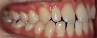 上顎側切歯矮小歯による上下前歯のスペースの発現
