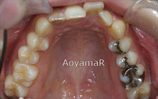 上顎右側側切歯失活歯 / 下顎側切歯１本欠損による上顎歯列の叢生