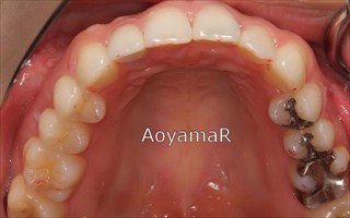 上顎右側側切歯失活歯 / 下顎側切歯１本欠損による上顎歯列の叢生