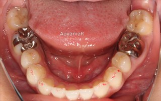上顎右側側切歯失活歯 / 下顎側切歯１本欠損による上顎歯列の叢生