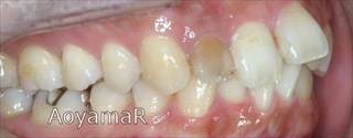 上顎右側側切歯失活歯 / 下顎側切歯１本欠損による上顎歯列の叢生